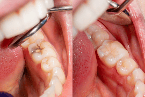 sealants on the surface of teeth